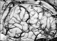 Photograph of exposed brain